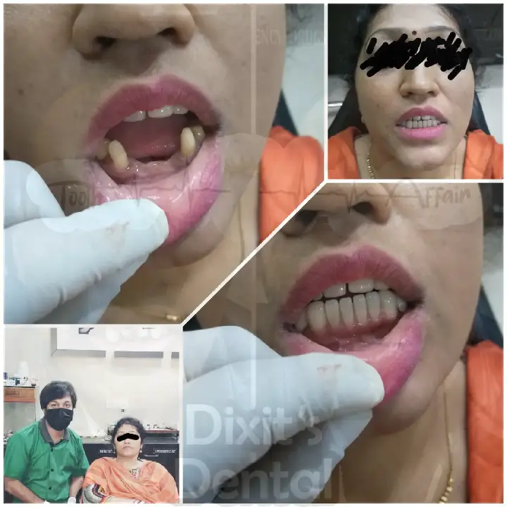 Before and after smile restoration